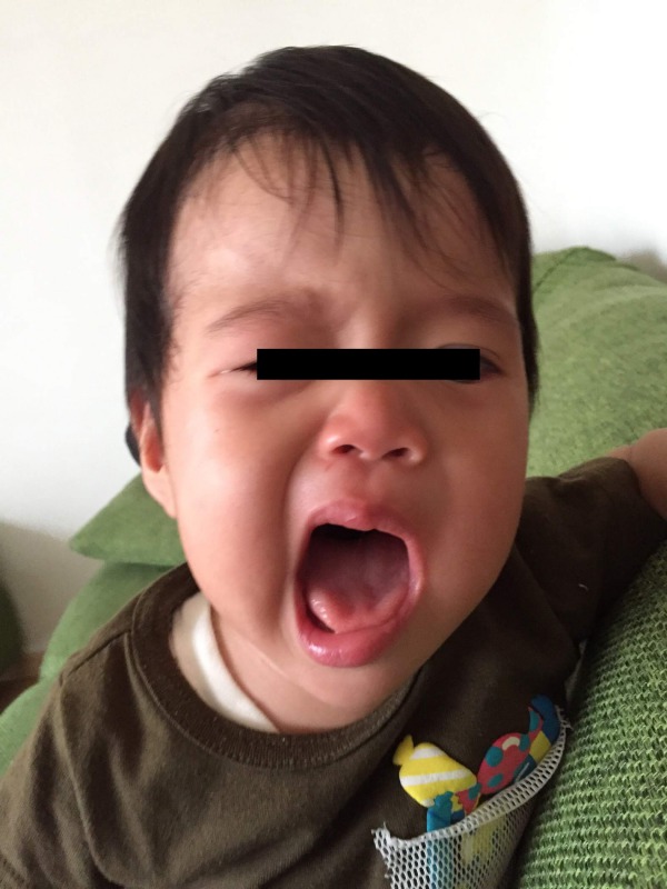 1歳児顔面神経麻痺